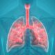 Hipertensión Pulmonar