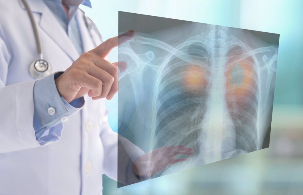 cáncer de pulmón