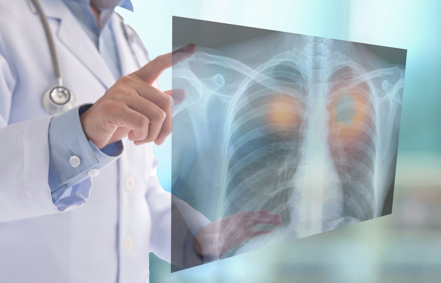 cáncer de pulmón