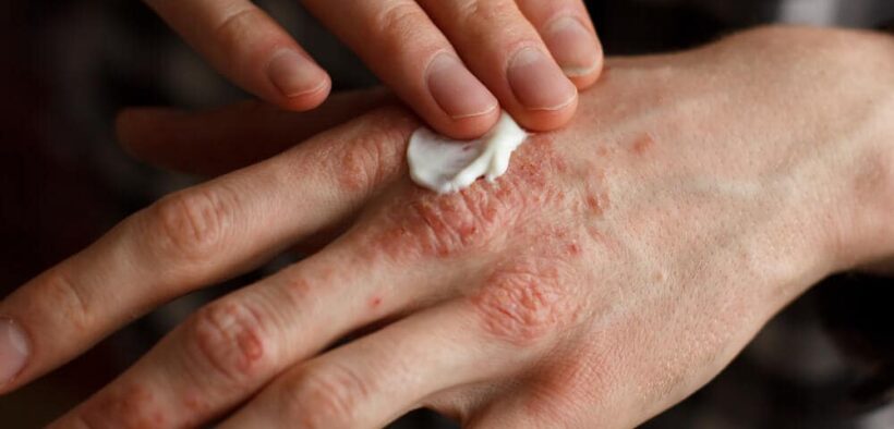 Psoriasis